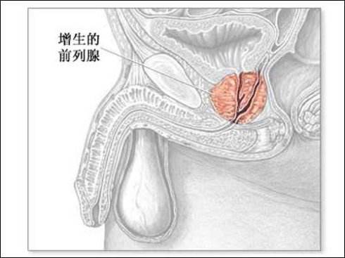 苏州治疗前列腺炎医院