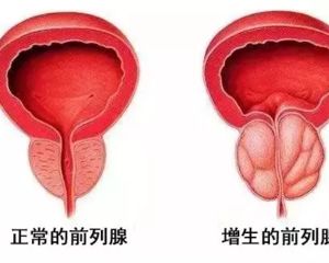 苏州治疗前列腺炎哪家医院好